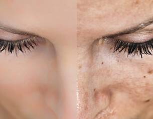 Comparaison avant/apres des cils, montrant une peau lisse a gauche et une peau avec des imperfections a droite.