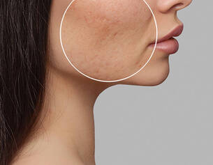 enlever-cicatrice-acne