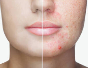 acide-salicylique-et-acne-quelle-efficacite