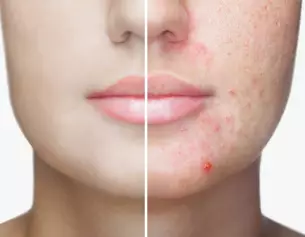 Visage divise en deux : cote gauche sans imperfections, cote droit presentant de l'acne et des cicatrices.