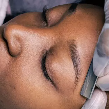 dermaplaning