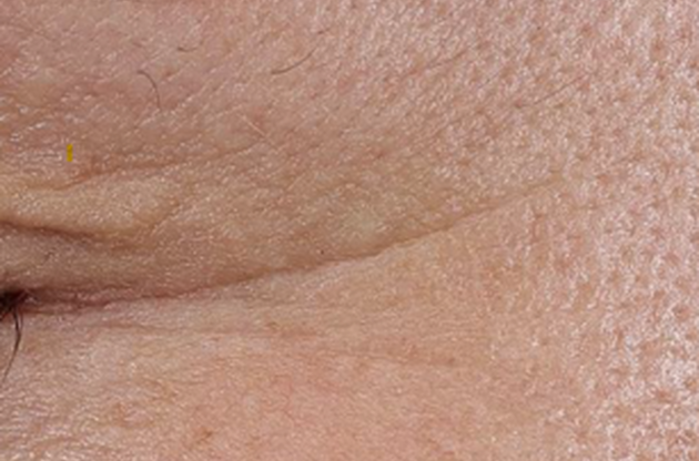 Gros plan sur la peau d'un visage, montrant des textures, des pores et des ridules.