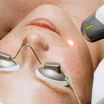 Resurfaçage de la peau au laser ablatif | SkinCeuticals