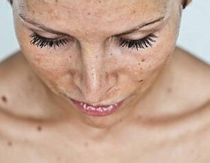 Femme regardant vers le bas, avec des cils longs et une peau marquee par des taches. Eclairage doux, ambiance intime.