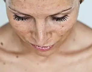 Femme regardant vers le bas, avec des cils longs et une peau marquee par des taches. Eclairage doux, ambiance intime.