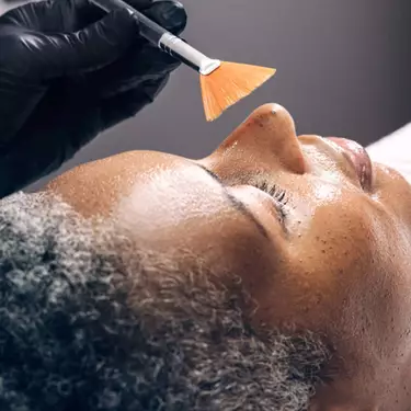 peeling chimique medium