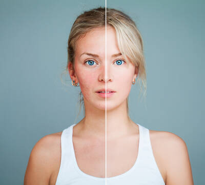 Se debarrasser de                l’acne rosacee