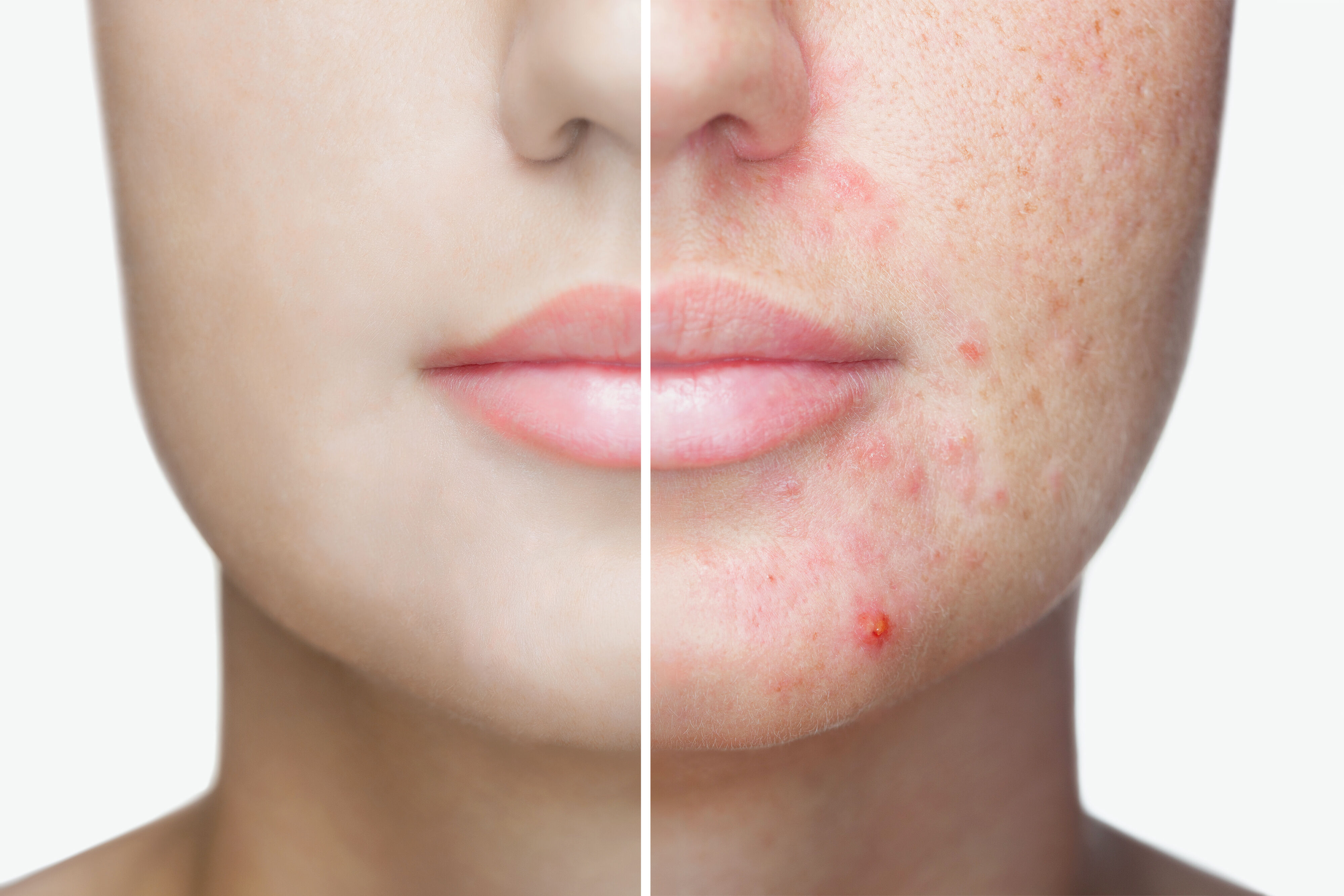 Utilisation de l’acide salicylique pour corriger l’acne