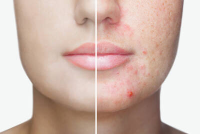Utilisation de l’acide salicylique pour corriger l’acne