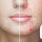 Utilisation de l’acide salicylique pour corriger l’acne