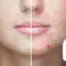 Utilisation de l’acide salicylique pour corriger l’acne