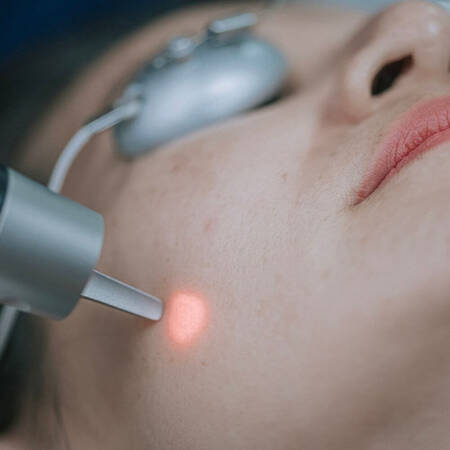 taches brunes elimination laser