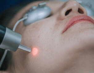 Femme recevant un traitement facial avec un dispositif laser sur la joue, portant des lunettes de protection.