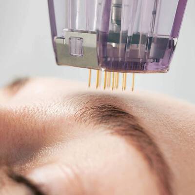 microneedling morpheus8