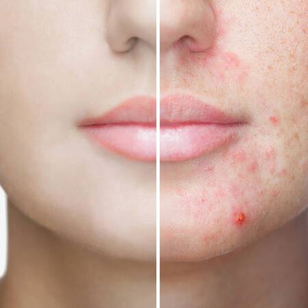 acide salicylique bienfaits