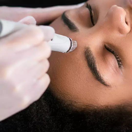 Microdermabrasion