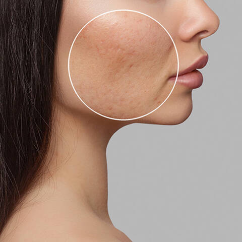 Comment enlever les
                cicatrices d’acne ?