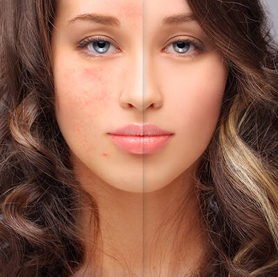 Image montrant une comparaison drastique du visage d'une jeune femme, avec une moitie presentant des imperfections de la peau et l'autre moitie parfaitement lisse et sans defauts.