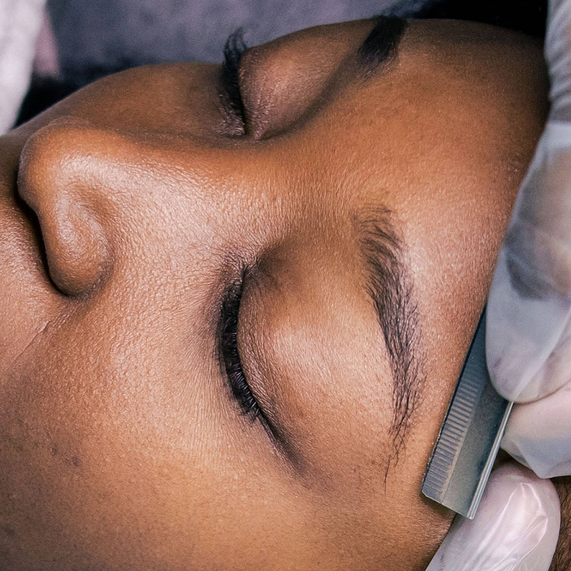 dermaplaning