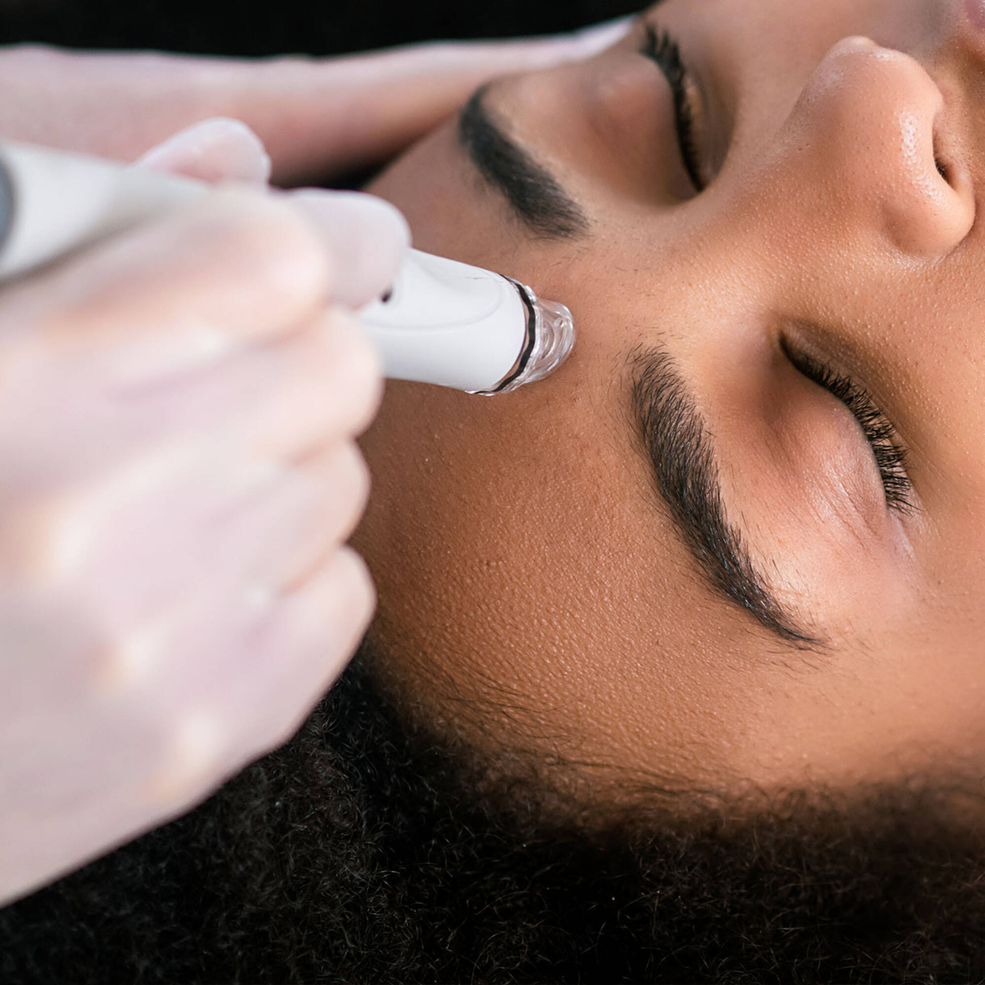 microdermabrasion visage