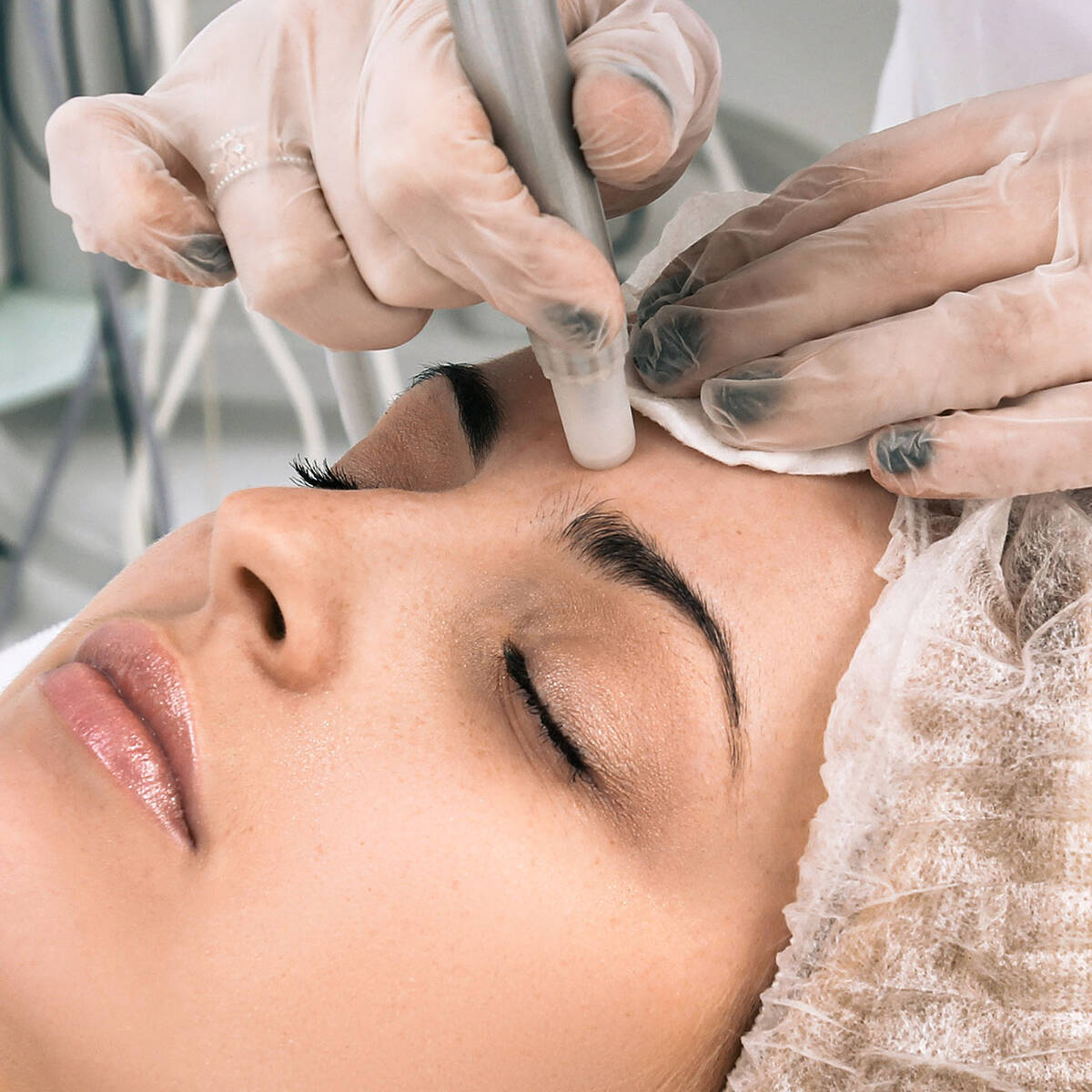 Pelleve raffermissement peau radiofrequence