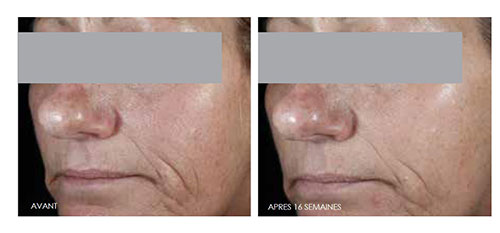 *Étude Clinique clinique sur 15 personnes de 12 semaines sur 55 femmes, 45-60 ans. CEFerulic-Avant-Apres